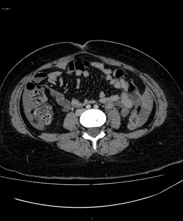 Post surgical termination of pregnancy -uterine perforation | Radiology ...