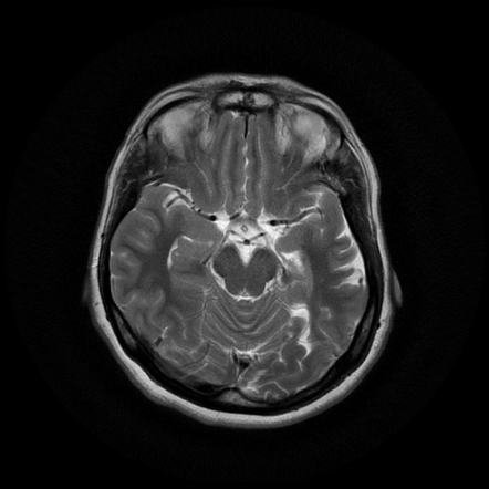 Mesial temporal sclerosis | Image | Radiopaedia.org