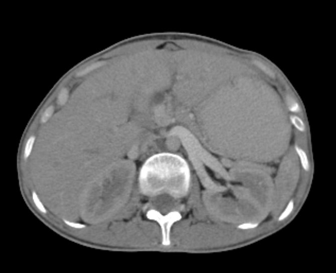 SMA syndrome and nutcracker phenomenon | Image | Radiopaedia.org