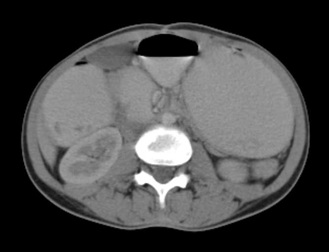 SMA syndrome and nutcracker phenomenon | Image | Radiopaedia.org