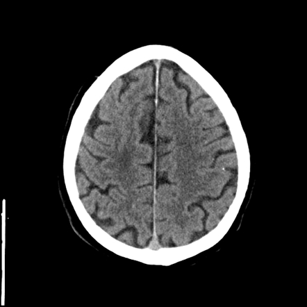 Salted pretzel sign (CT head) | Radiology Reference Article ...