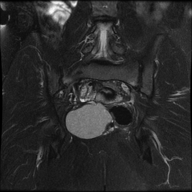 Tailgut Cyst 