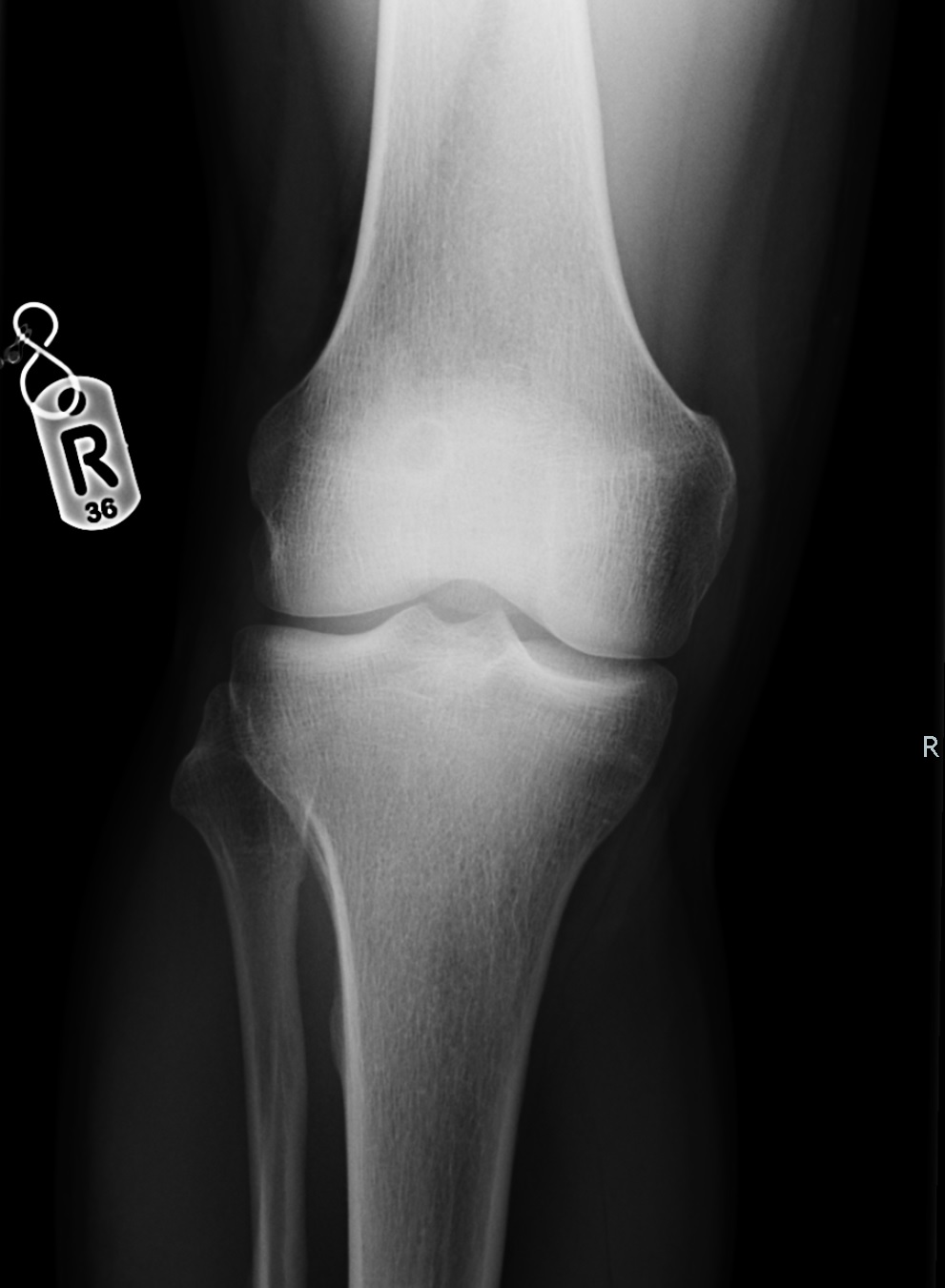 Dorsal Defect Of The Patella Image