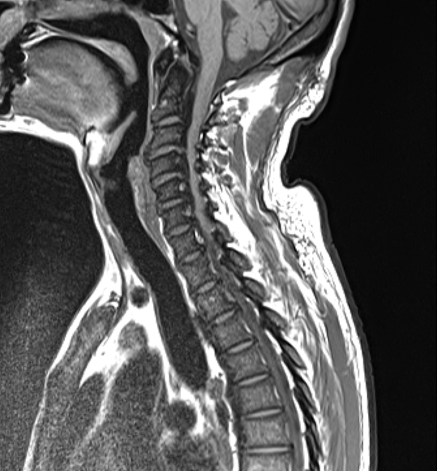 Ossification Of Posterior Longitudinal Ligament Image