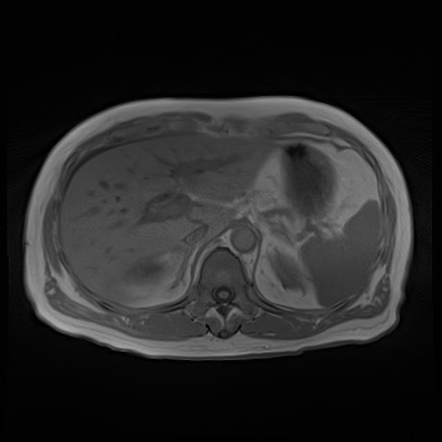 Acute Cholecystitis | Image | Radiopaedia.org