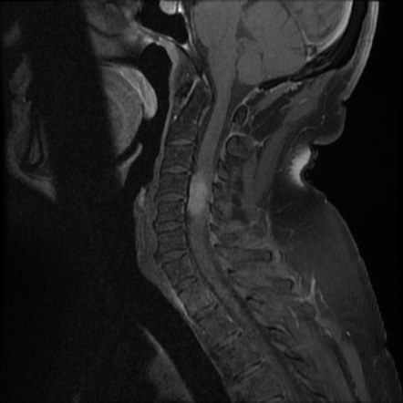 Cervical schwannoma | Image | Radiopaedia.org