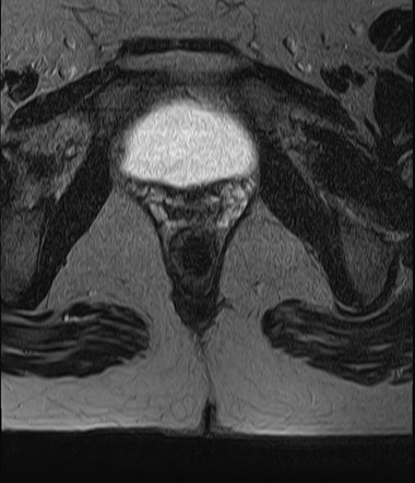 Pilonidal Sinus Ultrasound