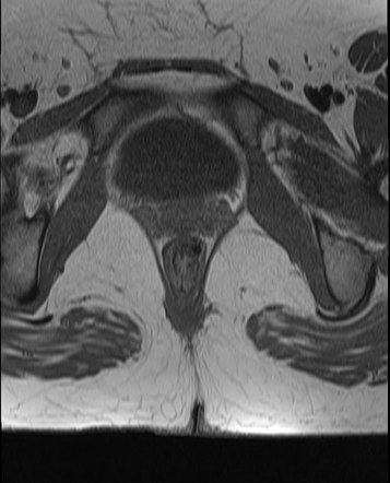 Pilonidal Sinus | Image | Radiopaedia.org