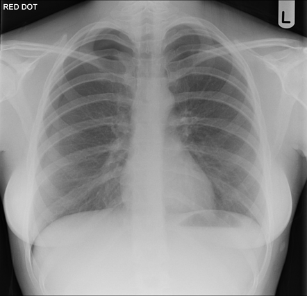 Pneumothorax | Radiology Case | Radiopaedia.org