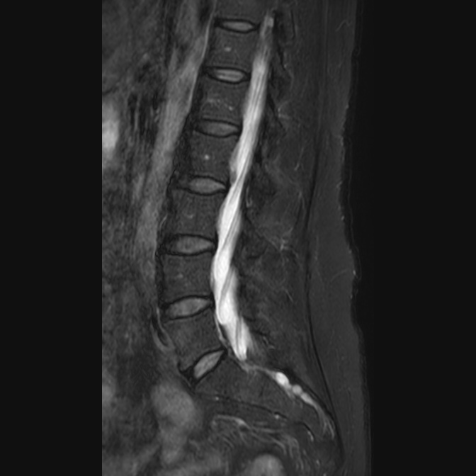 Lumbar foraminal disc extrusion | Image | Radiopaedia.org