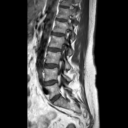 Lumbar Foraminal Disc Extrusion 