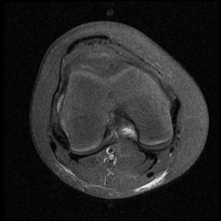 Osgood-Schlatter disease | Radiology Case | Radiopaedia.org