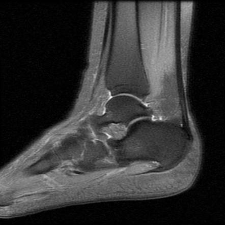 Os calcaneus secundarius | Image | Radiopaedia.org