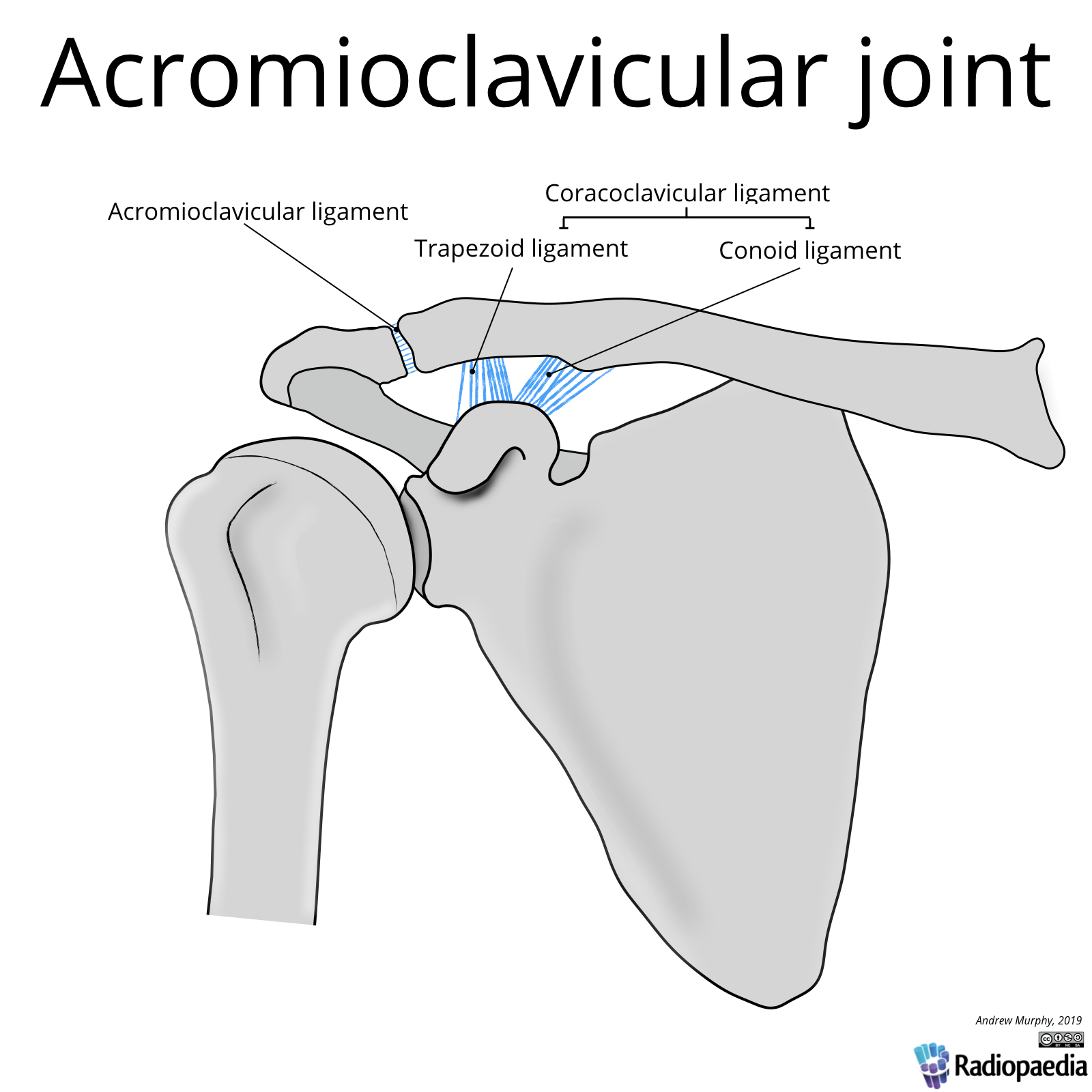 Rockwood classification of acromioclavicular joint injury | Image ...