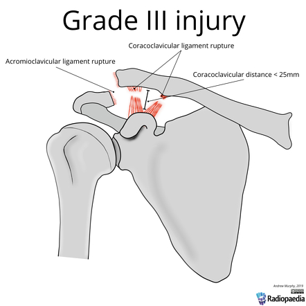 Rockwood classification of acromioclavicular joint injury | Image ...