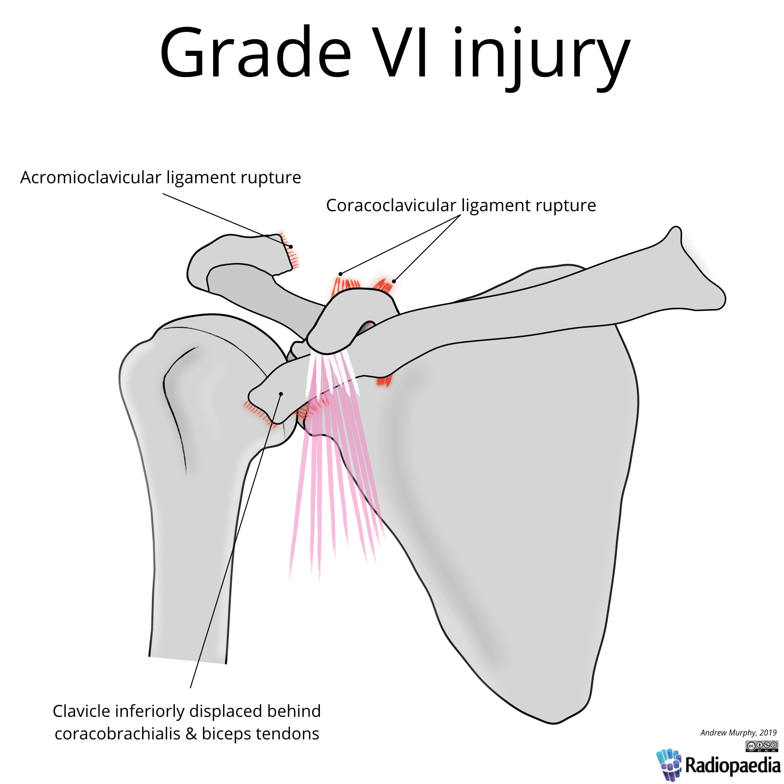 Rockwood Classification Of Acromioclavicular Joint Injury Image