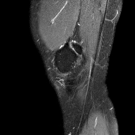 Fabella in the medial head of the gastrocnemius | Image | Radiopaedia.org