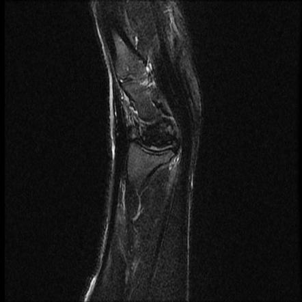 Kienböck disease | Image | Radiopaedia.org