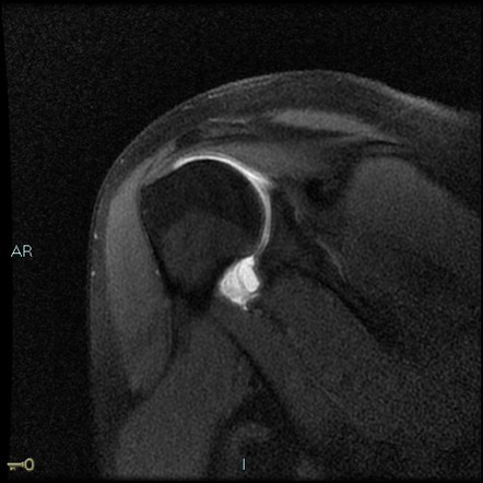 Humeral avulsion of glenohumeral ligament (HAGL) | Image | Radiopaedia.org