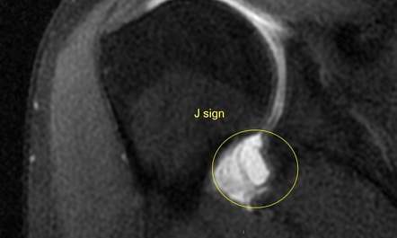 Humeral Avulsion Of Glenohumeral Ligament (HAGL) | Radiology Case ...