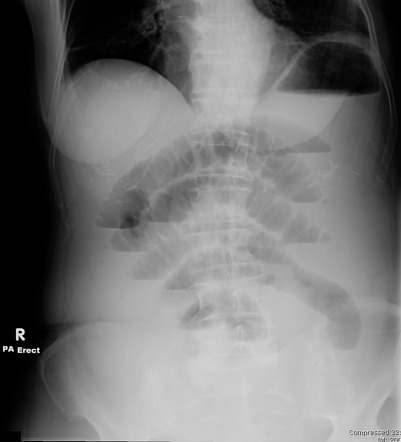 Small bowel obstruction on AXR | Image | Radiopaedia.org