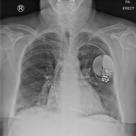 Patchy right lower lobe consolidation | Radiology Case | Radiopaedia.org