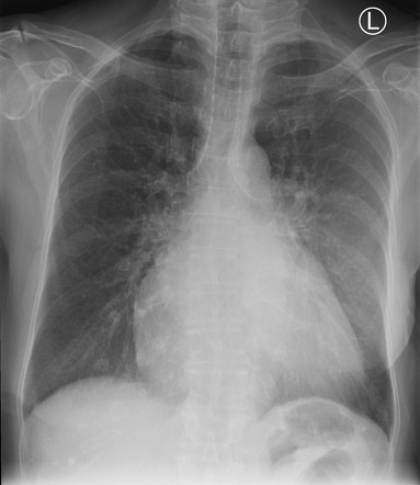 Costal cartilage calcification and unilateral breast implant ...