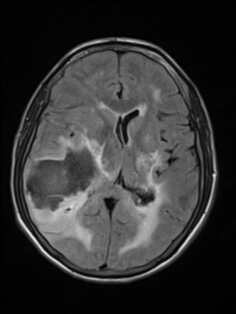 Chronic hypertensive encephalopathy | Image | Radiopaedia.org