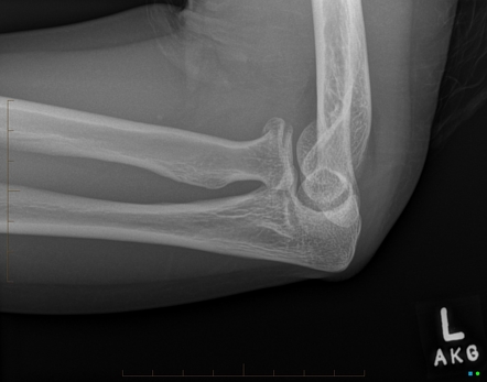 Radial head fracture | Radiology Case | Radiopaedia.org