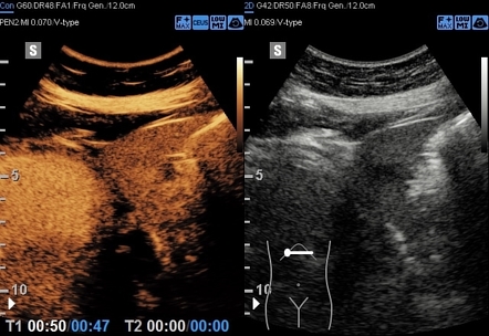 Flash Filling Hemangioma CEUS Image Radiopaedia Org   80607d16741c18544cc319fac58802 Gallery 