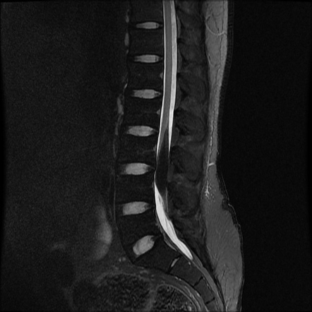 Intradural spinal lipoma | Radiology Reference Article | Radiopaedia.org