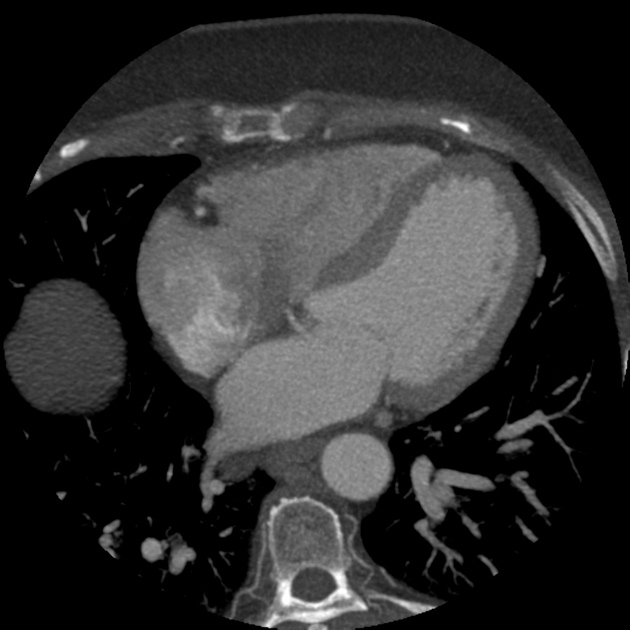 Anomalous Origin Of Left Circumflex Artery From Right Coronary Sinus Radiology Case Radiopaedia Org