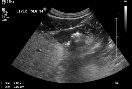 Hepatic hemangioma (CEUS) | Image | Radiopaedia.org