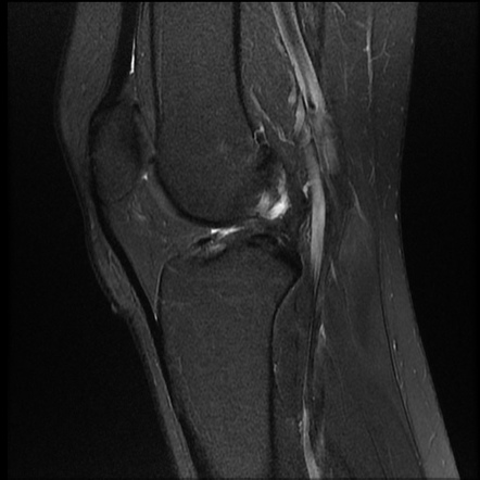 Anterior cruciate ligament rupture - chronic | Image | Radiopaedia.org