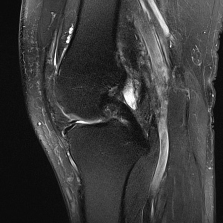 Central osteophyte | Image | Radiopaedia.org