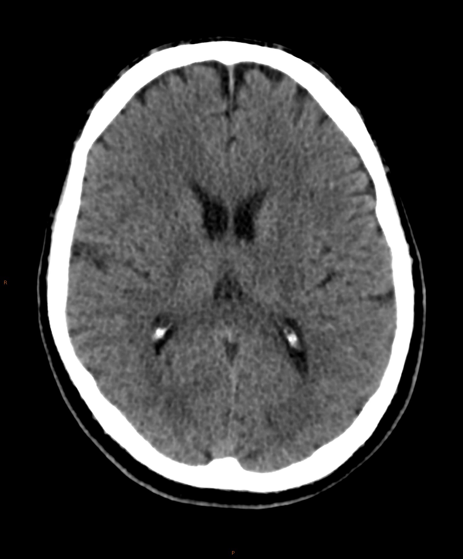 Posterior circulation infarct | Image | Radiopaedia.org