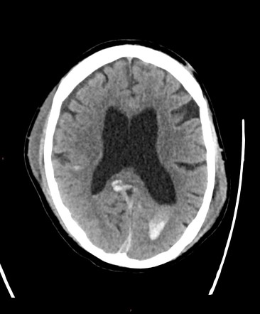 Radiology Quiz 17921 | Radiopaedia.org | Playlist 'FRANZCR 01A Neuro ...