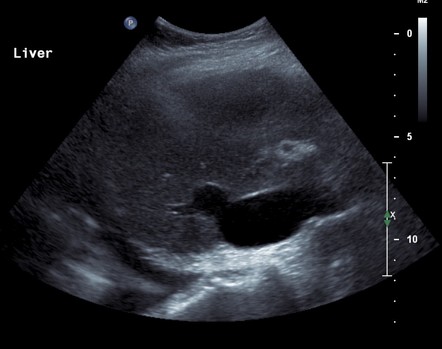 Liver duck (Rorschach radiology) | Radiology Case | Radiopaedia.org