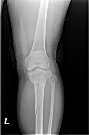 Tibial Plateau Fracture: Schatzker Type Vi 