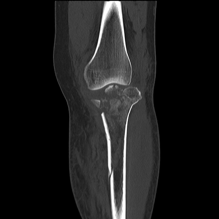 Tibial plateau fracture: Schatzker type VI | Image | Radiopaedia.org