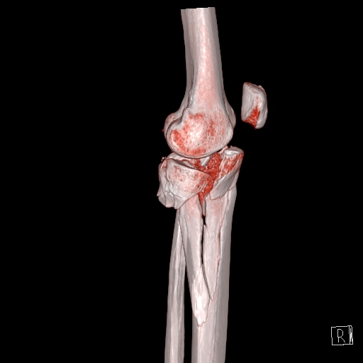 Tibial Plateau Fracture: Schatzker Type VI | Image | Radiopaedia.org