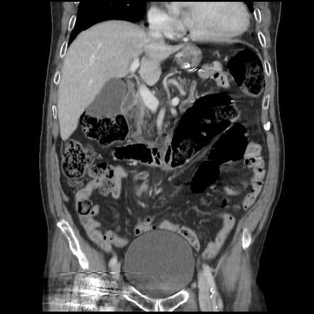 Sigmoid volvulus | Image | Radiopaedia.org