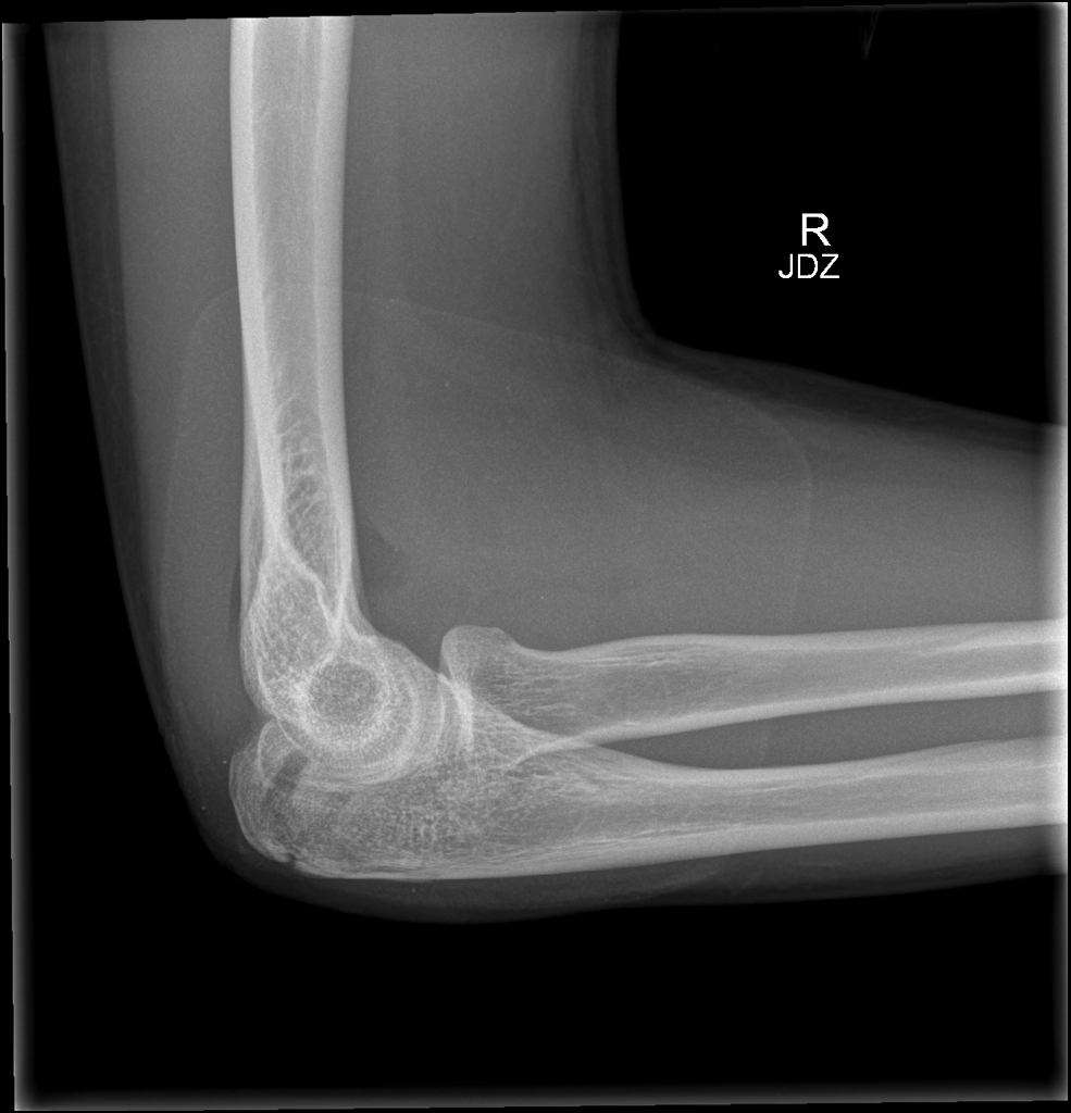 Olecranon fracture | Image | Radiopaedia.org