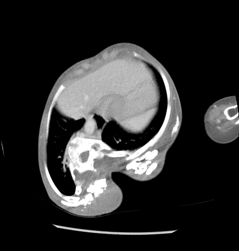 Juvenile hyaline fibromatosis | Image | Radiopaedia.org