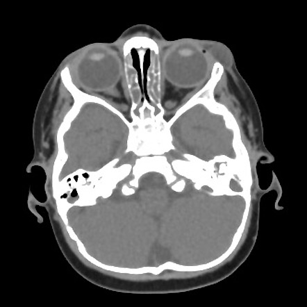 External angular dermoid cyst | Radiology Case | Radiopaedia.org