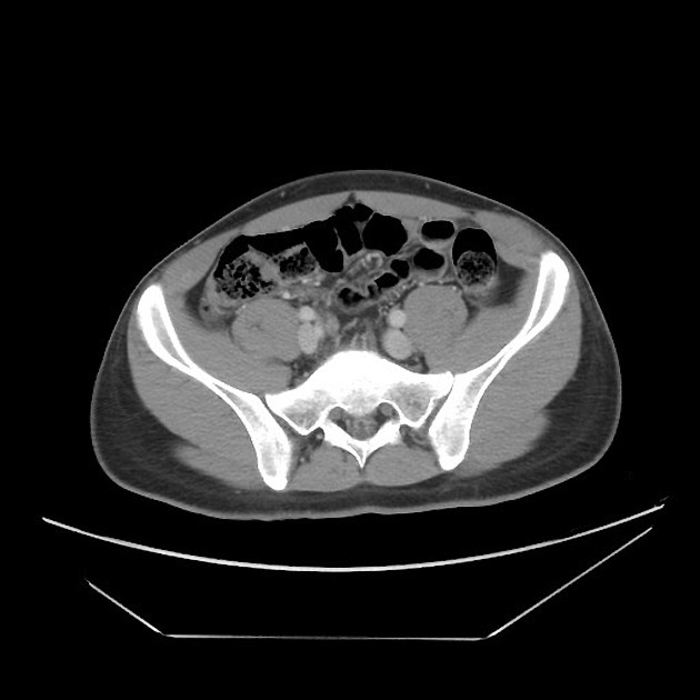 Featured image of post Appendicitis Ct Radiopaedia It is a very common condition in general radiology practice and is one of the main