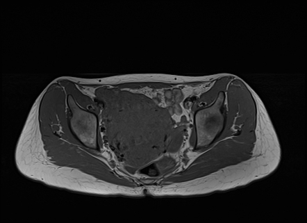 Diffuse Uterine Leiomyomatosis | Image | Radiopaedia.org