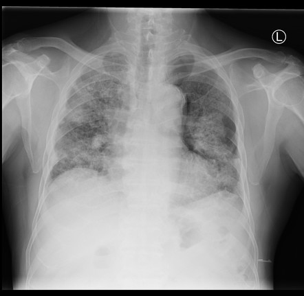 Silicosis | Radiology Reference Article | Radiopaedia.org