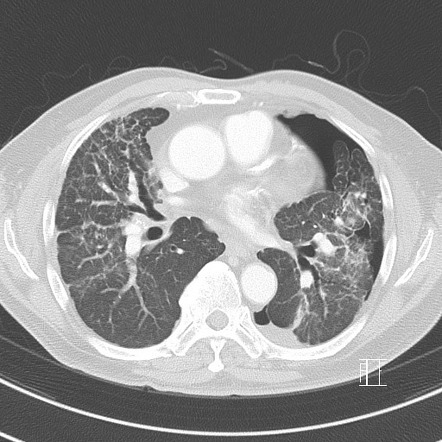 Silicosis With Progressive Massive Fibrosis - Pneumothorax 