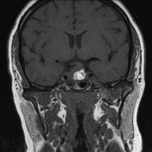 Pituitary Macroadenoma | Image | Radiopaedia.org